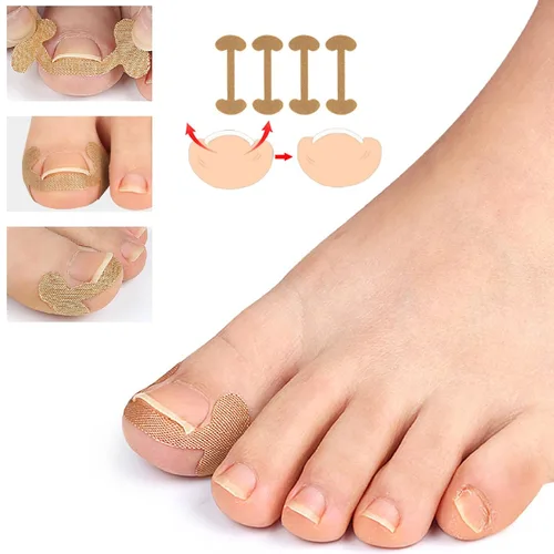 Vista 4 de Juego profesional de uñas encarnadas con tiras transpirables de uñas encarnadas, tiras correctoras de uñas de los pies, parche corrector de uñas