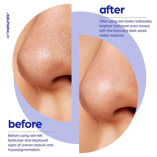 Vista 6 de ArtNaturals - Suero facial de ácido glicólico, vitamina C y aloe vera, exfolia y minimiza los poros, reduce el acné, los brotes y la apariencia
