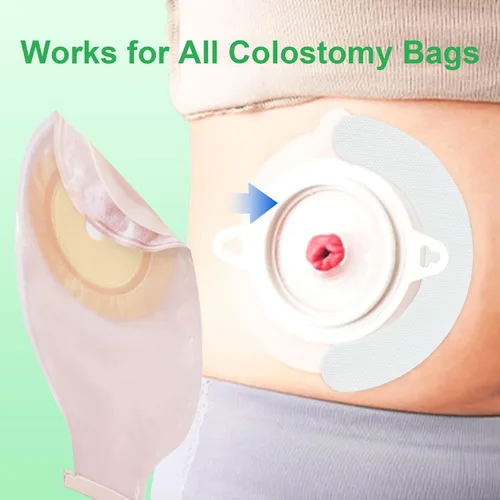 Vista 2 de 20 tiras médicas de barrera de piel para bolsas de estoma de colostomía, cinta adhesiva para la piel de barrera de ostomía