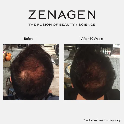 Vista 10 de Zenagen Revolve - Tratamiento de pérdida de cabello para hombres