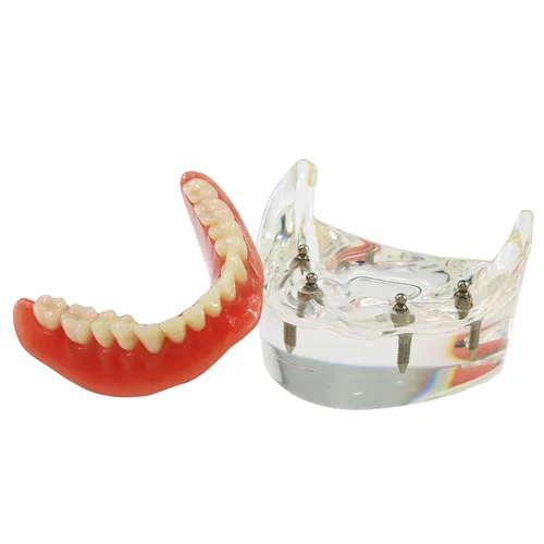 Vista 6 de Demostración inferior inferior inferior de la restauración del modelo M6003 Typodont Sobredentadura 4 implantes inferior inferior de los dientes