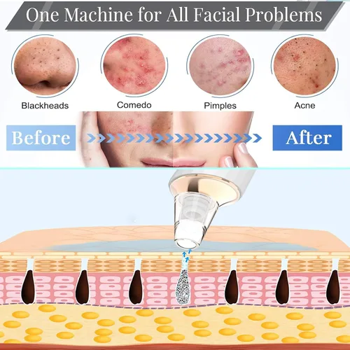 Vista 5 de Aspiradora de poros para eliminar puntos negros, limpiador facial recargable por USB, kit de eliminación de puntos negros con 3 potencia de succión