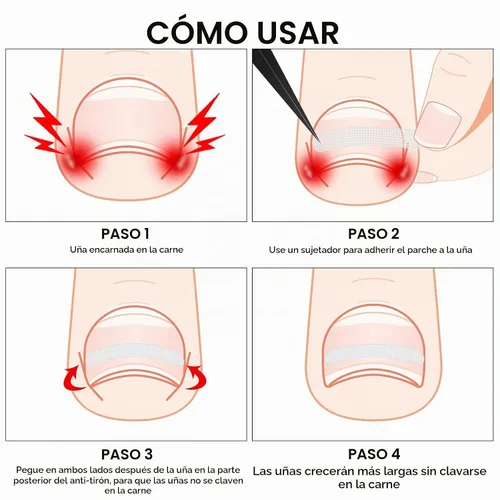 Vista 5 de 60 tiras correctoras de uñas encarnadas, corrección de uñas encarnadas, corrección de uñas, clip para enderezar uñas, parche curvo corrector de uñas