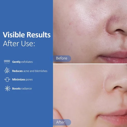 Vista 3 de Hicream Almohadillas de ácido glicólico, tónico exfoliante facial de doble textura para el cuidado de los poros y la luminosidad de la piel