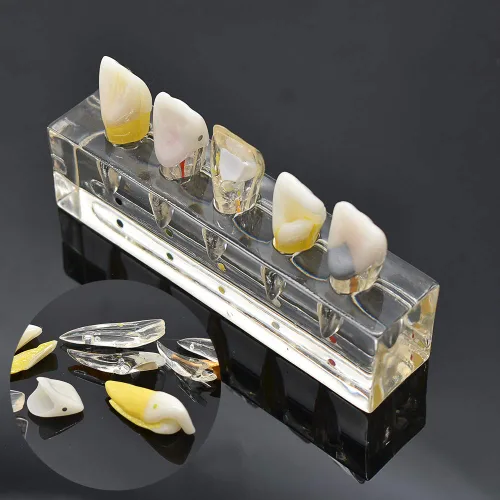 Vista 6 de Modelo patológico de restauración de pulpa dental de diente frontal, modelo endodóntico humano
