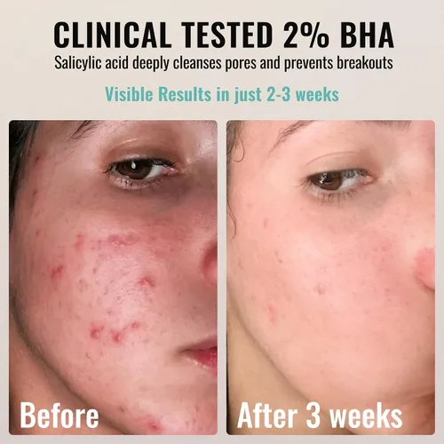 Vista 6 de ADM 2% BHA AHA - Exfoliante líquido – Suero de ácido salicílico – Minimizador de poros, pelado suave para puntos negros y arrugas con ácido