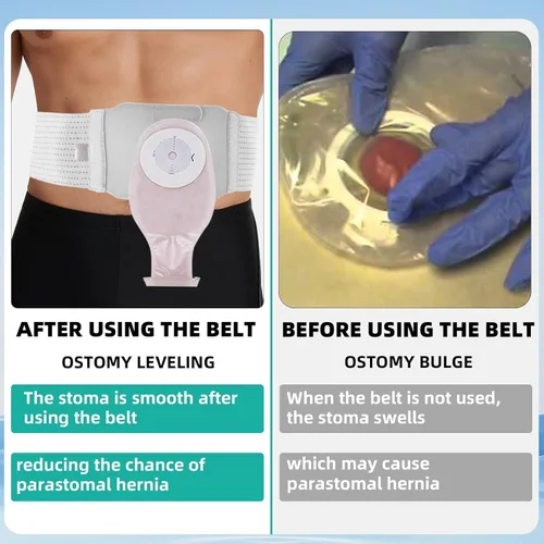 Vista 4 de Cinturón de soporte de ostomía, cinturón de soporte ajustable para estomía, cinturón de hernia para ostomía médica, cinturón universal de ostomía