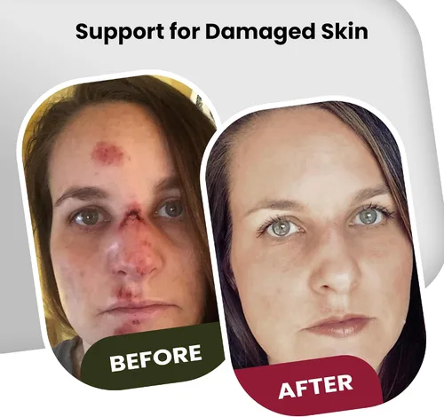 Vista 2 de Brave Soldier Ungüento antiséptico curativo - Mejor crema para el cuidado de heridas y reparación de la piel con aceite de árbol de té - Suministros