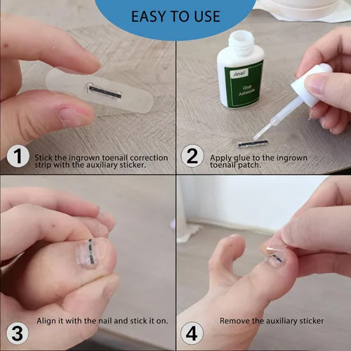 Vista 5 de Paquete de 10 piezas de corrector de uñas encarnadas de aleación de titanio, parche de reparación de uñas curvas, herramienta de corrección física