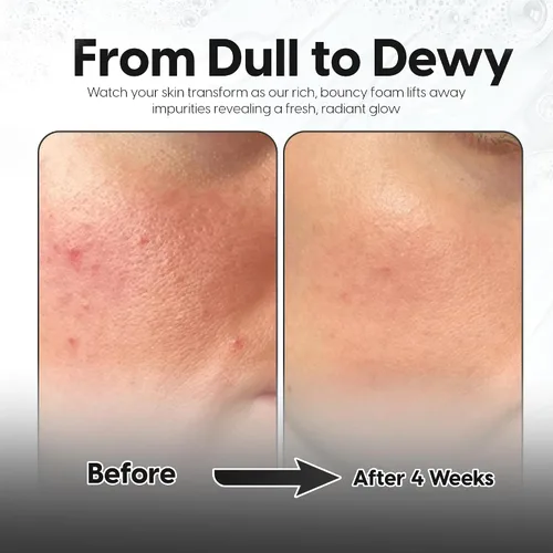 Vista 3 de 2 % de ácido salicílico + 5 % ácido láctico para cara y cuerpo – Brotes, queratosis pilaris, pelos encarnados, psoriasis y minimiza los poros