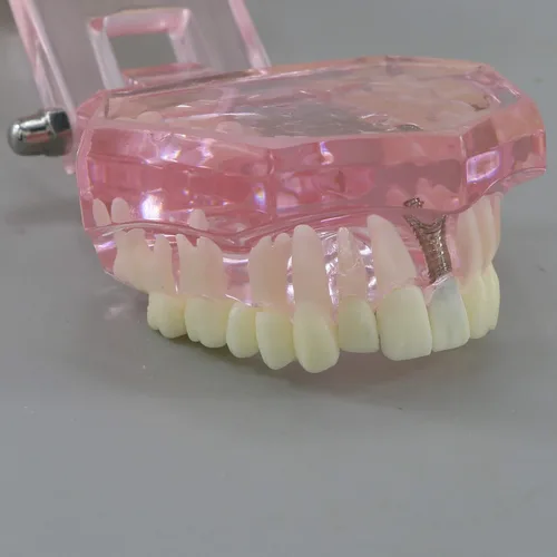 Vista 8 de Demostración oral del puente de la patología del color rosado de los dientes de Typodont de la restauración del implante dental M2001