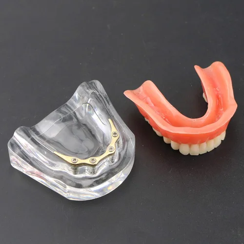 Vista 7 de Dental Dientes Modelo Oro Plata Demostración Color Practise Enseñanza Demo 4 Implante (GOLD BAR)