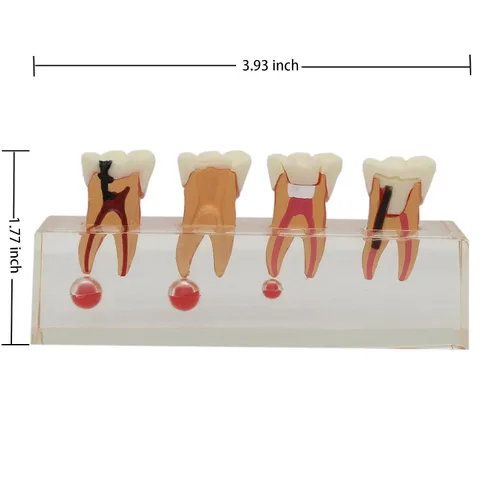 Vista 6 de Modelo de tratamiento endodóntico Dentalmall, de cuatro etapas, para enseñar a estudiantes, modelo 4018
