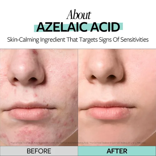 Vista 4 de RECIPE - Ampolla calmante de ácido azelaico 10, suero calmante, suero facial para pieles sensibles, cuidado de la piel coreano para brotes leves