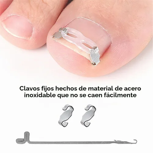 Vista 4 de Juego de herramientas de corrección de uñas encarnadas, 2 clips de inserción de acero inoxidable para tratamiento de uñas encarnadas, tiras