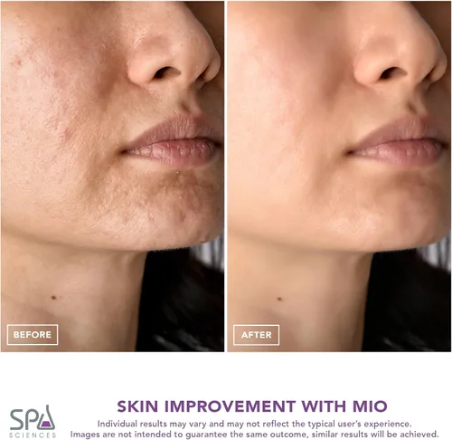 Vista 6 de Spa Sciences MIO Diamond Microdermabrasion - Removedor de puntos negros, herramienta de succión de poros, recargable, sistema de rejuvenecimiento