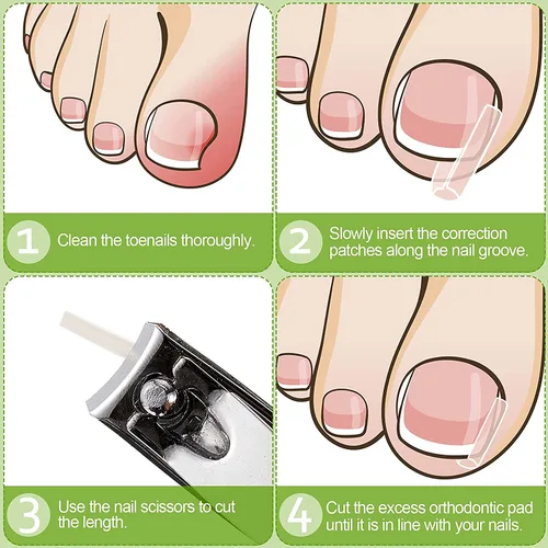 Vista 4 de Tiras correctoras de uñas encarnadas profesionales, 50 tiras correctoras de uñas encarnadas, tiras curvadas para enderezar las uñas del pie, clips