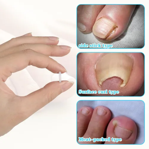 Vista 4 de (50+1) Juego de tratamiento corrector de uñas encarnadas, kit profesional de eliminación de uñas encarnadas sin dolor con levantador de uñas