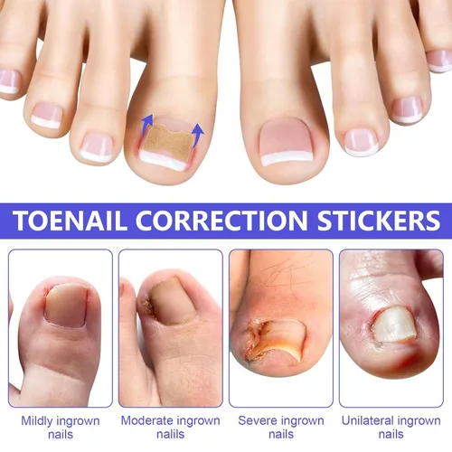 Vista 5 de Parche corrector de uñas encarnadas, 100 tiras correctoras de uñas encarnadas, parches de corrección de uñas de los pies, herramienta de tratamiento