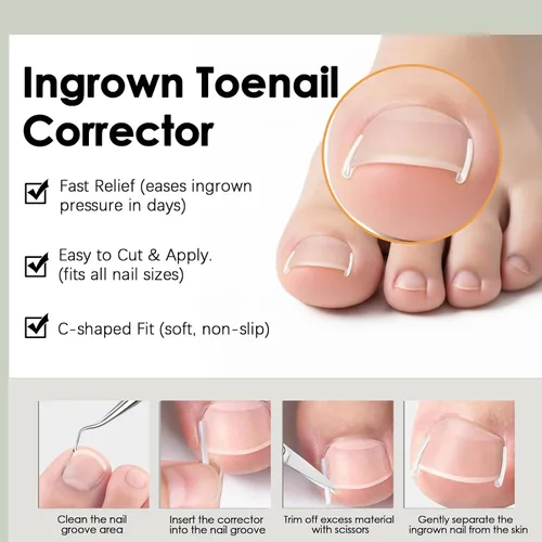Vista 5 de Juego de corrector de uñas encarnadas, kit profesional de tratamiento de uñas encarnadas con tiras de corrección transpirables, parches curvos