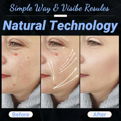 Vista 5 de UUPAS - Varita facial de alta frecuencia, portátil de mano 4 en 1, máquina facial azul de alta frecuencia con 4 tubos azules diferentes para uso