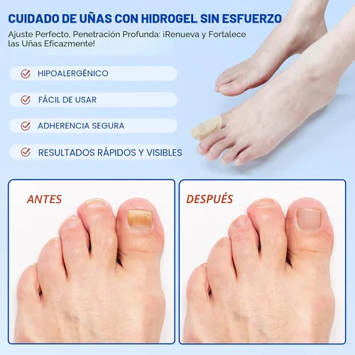Vista 5 de Parches de uñas para uñas de los pies, 21 parches de cuidado de uñas de hidrogel, soporte y protección de uñas durante la noche, fácil de aplicar
