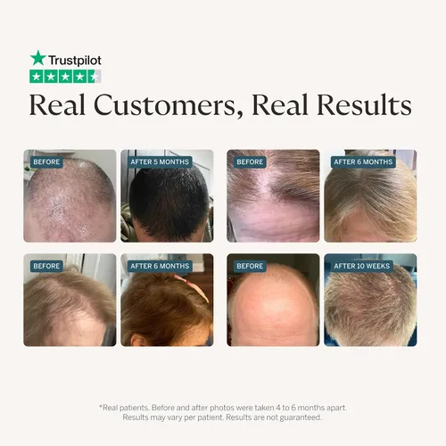 Vista 2 de Suplemento Happy Head para el crecimiento del cabello para hombres y mujeres – Cabello más grueso y abundante con Saw Palmetto, Ashwagandha