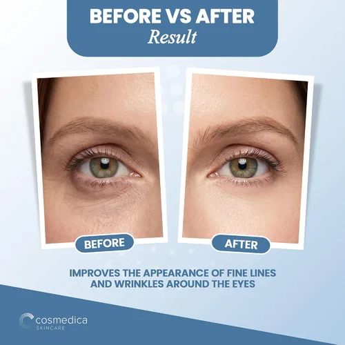 Vista 6 de Restaurador de contorno de ojos, antienvejecimiento, con ácido glicólico, reducción de líneas finas, hinchazón y ojeras; inmediata y duradera