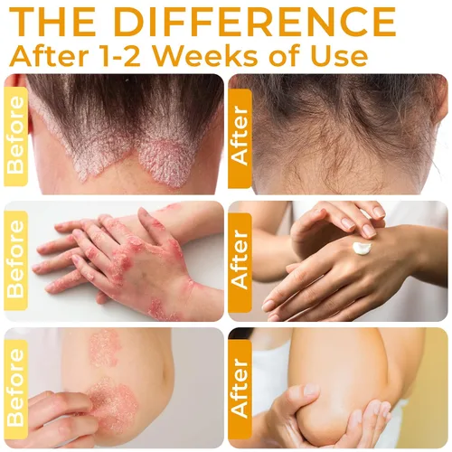 Vista 3 de Rida Hair Research Institute Crema para la psoriasis para el cuero cabelludo, la cara y el cuerpo Crema de eczema para adultos Tratamiento