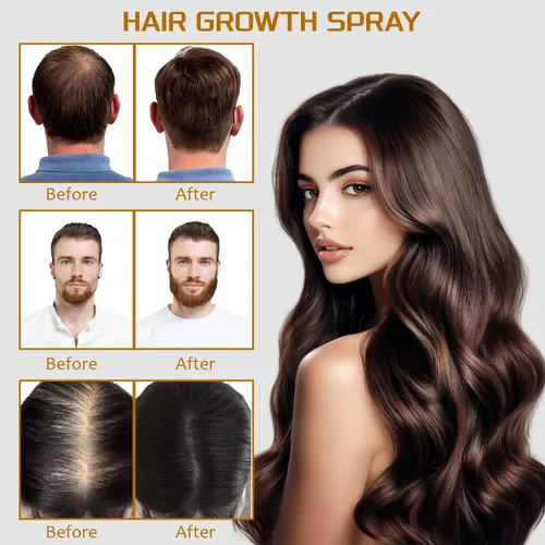 Vista 4 de Spray de minoxidil al 5% con biotina de 3.4 fl oz, tratamiento de recrecimiento para hombres y mujeres, promueve el cabello más grueso, más fuerte