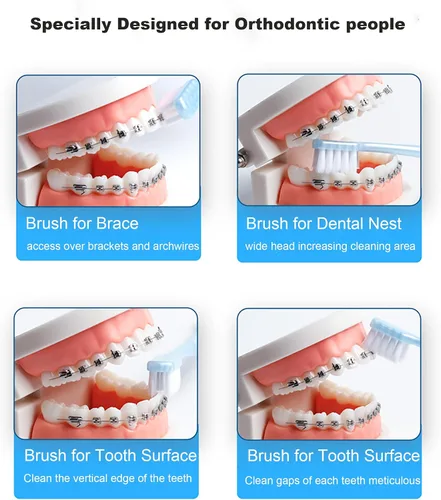 Vista 3 de Cepillo dental de ortodoncia en forma de V para aparatos ortopédicos, para niños, adolescentes y adultos, para dientes sensibles, para encías Azul