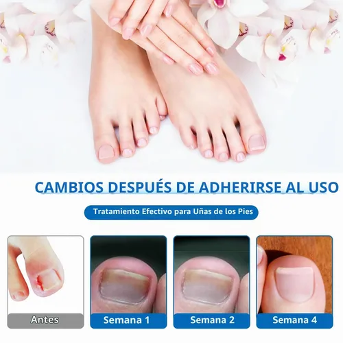 Vista 5 de Kit de eliminación de uñas encarnadas, 50 tiras correctoras de uñas encarnadas sin dolor con levantador de uñas de los pies, lima sin dolor, kit