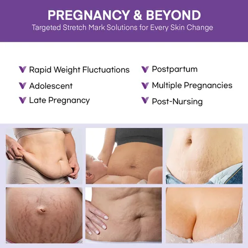 Vista 4 de Crema para estrías para mujeres embarazadas: tratamiento de estrías para el embarazo - Mantequilla de vientre para mujeres embarazadas - Loción