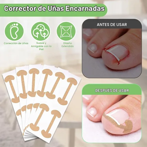 Vista 4 de Juego de corrector de uñas encarnadas con tiras correctoras, kit de herramientas profesionales para uñas de los pies, incluye tiras transpirables