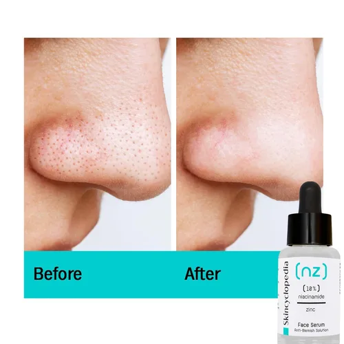 Vista 2 de Suero facial puro de niacinamida y zinc, solución antimanchas y minimizador de poros, control del acné y equilibrio de aceite, elimina marcas