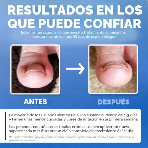 Vista 5 de Tratamiento del hogar para uñas encarnadas CurveCorrect
