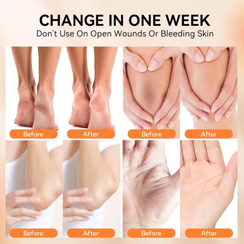 Vista 8 de LANBENA Crema de urea 40 por ciento para pies más 2% ácido salicílico 3.52 onzas, crema de pies y crema de manos máxima fuerza con aloe vera