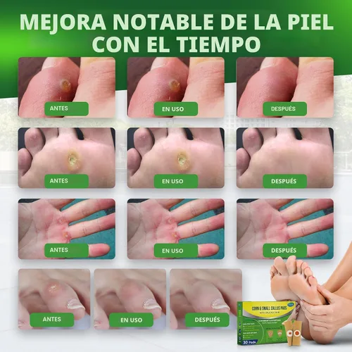 Vista 4 de Ulensy Almohadillas removedoras de maíz para pies de los pies: paquete de 30 unidades de tratamiento extra fuerte con ácido salicílico - vendajes