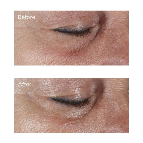 Vista 4 de Perricone MD Crema reafirmante hipoalergénica para ojos 0.5 onzas