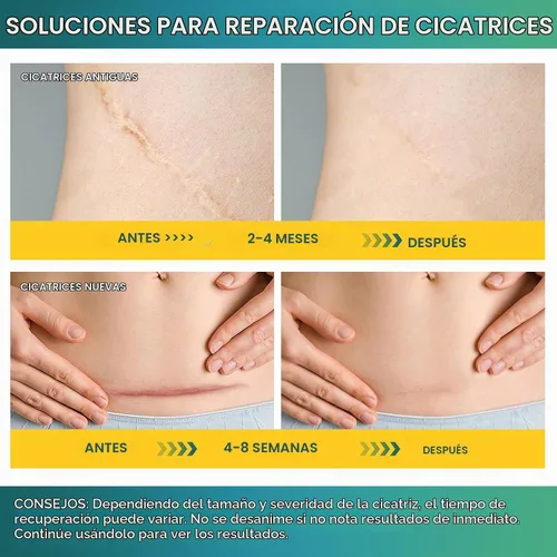 Vista 4 de Cinta de silicona para cicatrices, hojas de silicona para cicatrices (rollo de 1.6 x 59 pulgadas, rollo de 4.9 ft), láminas de silicona