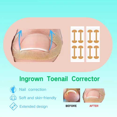Vista 3 de Juego de corrector de uñas encarnadas con parche de corrección de uñas curvas, kit de eliminación de uñas mejorado, herramientas de pedicura