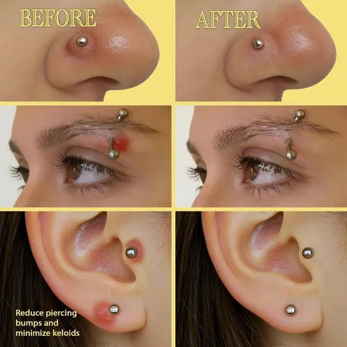 Vista 3 de BodyJ4You Eliminación de Protuberancias de Queloides de Piercing - Tratamiento Natural con Aceite para Protuberancias de Piercing - Limpiador