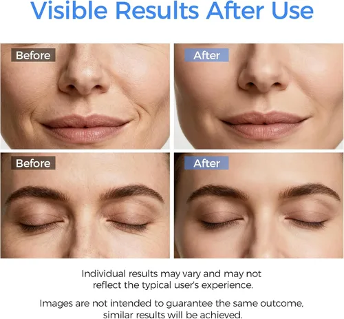 Vista 3 de Espátula Limpiadora de Piel Facial, Herramienta Removedora de Puntos Negros para Limpieza Profunda Facial, Espátula Facial Limpiadora de Poros con 4
