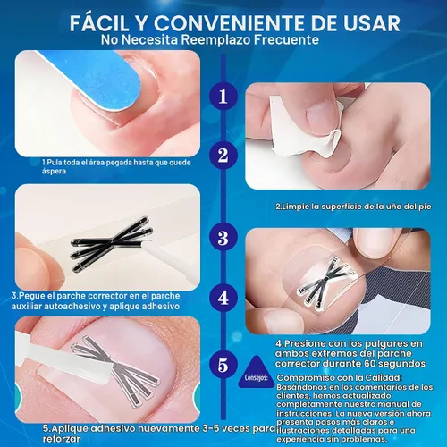 Vista 6 de Tratamiento de uñas encarnadas con forma mejorada de 6 ángulos, corrector de uñas encarnadas de aleación de titanio para un alivio rápido, kit