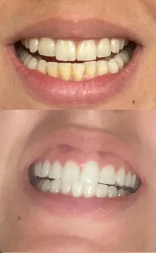 Vista 3 de Recarga de gel blanqueador dental 4X jeringas 44% peróxido de carbamida