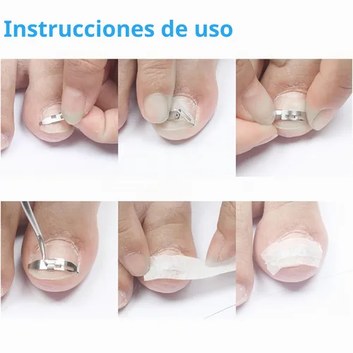 Vista 9 de Corrección de uñas encarnadas plateadas de 17 a 0.866 in ajustable de acero inoxidable corrector de uñas de pedicura paroniquia herramienta