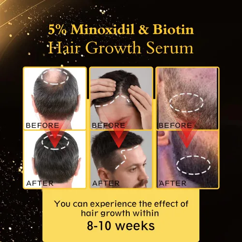 Vista 6 de Aceite de minoxidil para el crecimiento del cabello al 5% para hombres y mujeres, suero tópico extra fuerte para la pérdida del cabello, promueve