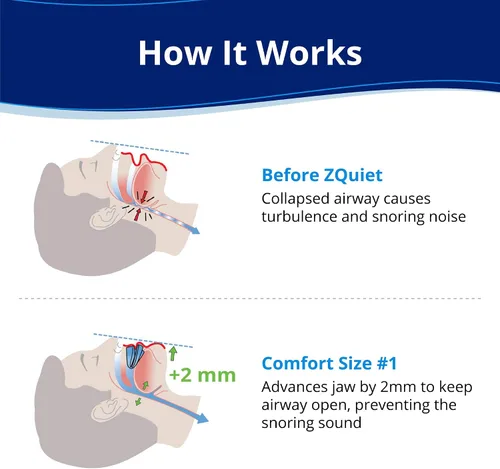 Vista 2 de ZQuiet, boquilla antirronquidos, tamaño cómodo #1, recarga única, transparente, fabricada en EE. UU., sin BPA, material de grado médico