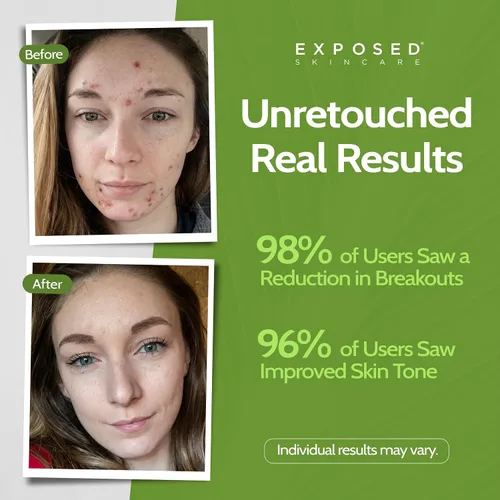Vista 3 de Exposed Skin Care Mascarilla facial de carbón activado para purificar la piel, regular la producción de aceite y minimizar visiblemente los poros