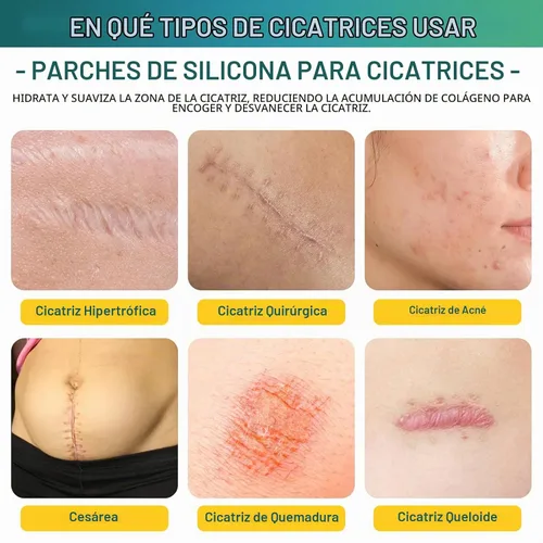 Vista 2 de Cinta de silicona para cicatrices, hojas de silicona para cicatrices (rollo de 1.6 x 59 pulgadas, rollo de 4.9 ft), láminas de silicona
